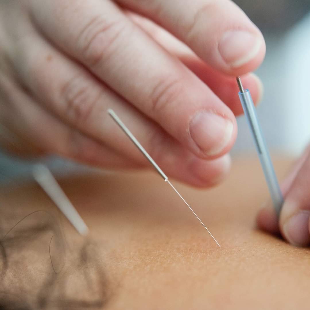 Acupuncture treatment, needle
